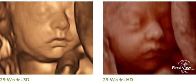 3D 4D HD Ultrasound Image Gallery - Firstview HD Ultrasound